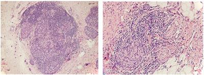 Pancreatogenic Diabetes in Children With Recurrent Acute and Chronic Pancreatitis: Risks, Screening, and Treatment (Mini-Review)